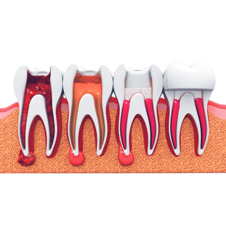 dental root canals